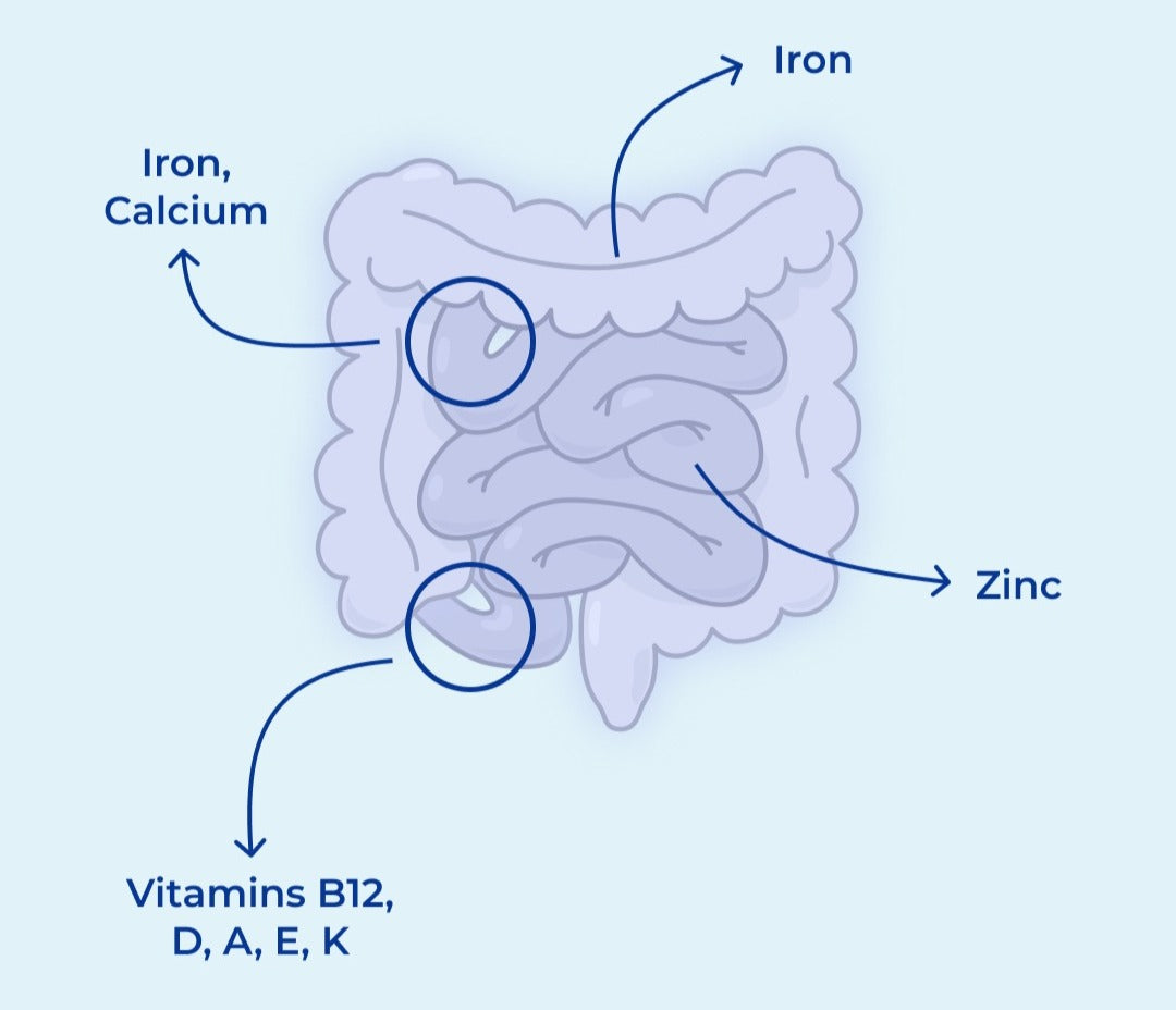 Maximizing Nutrition for IBD: Avoid Missing Key Nutrients"