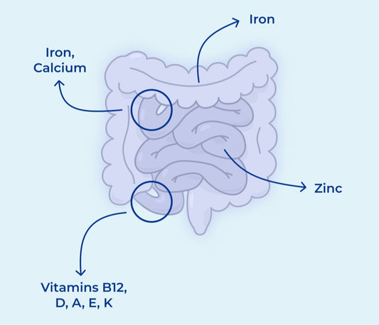Maximizing Nutrition for IBD: Avoid Missing Key Nutrients"